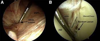 Hagl dannes av underkjølte vanndråper som fryser rundt en kondensasjonskjerne, som et støvfnugg eller en annen haglpartikkel. Arthroscopic View From Posterior Portal Confirming Humeral Avulsion Of Download Scientific Diagram