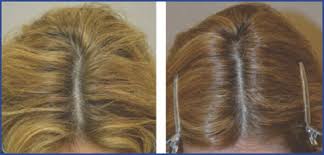 Many women take 100 mg in the morning and 100 mg in the afternoon. Medical Therapy For Female Pattern Hair Loss Fphl Hair Transplant Forum International