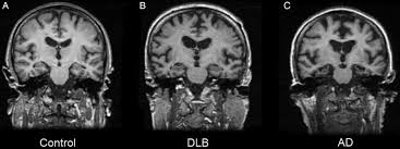 Lewy body dementia, also known as dementia with lewy bodies, is the second most common type of progressive dementia after alzheimer's disease dementia. Delirium And Dementia With Lewy Bodies Distinct Diagnoses Or Part Of The Same Spectrum Journal Of Neurology Neurosurgery Psychiatry