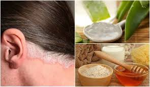 Sac Derisindeki Sedef Hastaligi Icin 5 Ev Tedavisi Sagliga Bir Adim Psoriasis Hair Psoriasis Scalp Psoriasis