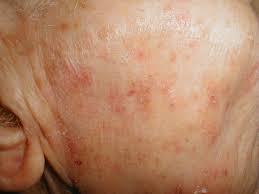 19.08.2011 · a form of keratosis that is considered precancerous is actinic keratosis. Actinic Keratoses Oregon Medical Research Center