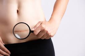 Een blindedarmontsteking is de meest voorkomende reden voor abdominale chirurgie bij kinderen. Chirurgische Hechtdraad Hecht Realistische Samenstelling Van De Blindedarmontsteking Met Uitzicht Op Chirurgische Interventieteken Op Realistisch Vrouwelijk Lichaam Gratis Vector