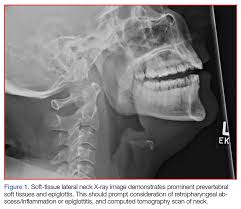 Image result for Epiglottitis