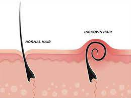 How Effective Is Using Tea Tree Oil For Ingrown Hair Ingrown Hair Ingrown Hair On Neck Treat Ingrown Hair