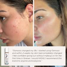 Real skin, real results. ✨ This Osmosis beauty embraced a holistic routine  and saw a visible difference in just weeks. Now confidently makeup-free and  glowing. Explore our approach to supporting blemish-prone skin