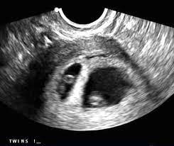 Parents will be eager to know whether they need to prepare for more than one baby on the way. 7 Weeks Pregnant With Twins Twiniversity