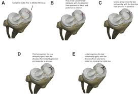 Arrow screen service replaced our lanai screens and all our window screens. Continuous Meniscal Suture In Radial Meniscal Tear The Hourglass Technique Sciencedirect