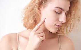 What your moles say about you · a mole in the middle of your forehead means you are very wise and insightful · a mole on the right side of your . Mole On Face Neck Lip And Elbow Meaning Hidden Messages On Different Body Parts