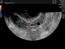 Image result for corpus luteum sonography)
