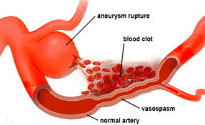 Any of these symptoms requires immediate. Best Treatment For Brain Aneurysm Delhi Cerebral Aneurysm Surgery India