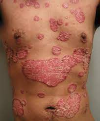 Severity Of Psoriasis Linked To Increased Risk Of Death Research Development World