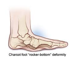 People with charcot foot also have peripheral neuropathy, which is decreased nerve sensation in the outer limbs. Charcot Foot Symptoms Causes Diagnosis Treatment Management