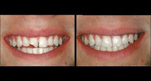 Learn more about different filling costs how much does a tooth filling cost? Improve Your Smile With Teeth Whitening In Cedar Park