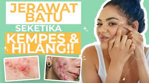 Namun, anda tidak perlu khawatir, karena jenis jerawat ini bisa dihilangkan bila ditangani dengan tepat. Jangan Panik Ini 6 Cara Menghilangkan Jerawat Batu Di Wajah Youtube