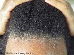 Treat your hair to a soothing, nourishing experience with a tea tree conditioner. Is That Dandruff Or Something More Serious Read The Article Here Http Blackhairinformation Com Growt Natural Hair Scalp Hair Scalp Fungus Dandruff Remedy