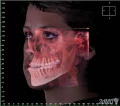 Comparison of three-dimensional surface-imaging systems