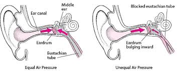 Image result for Eustachian Tube Dysfunction