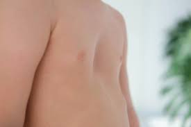 Image result for Pectus Excavatum