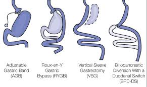 A bariatric surgeon will remove a large portion of the stomach of patients and leave a. Comparison Of Bariatric Surgical Procedures For Diabetes Remission Efficacy And Mechanisms Diabetes Spectrum