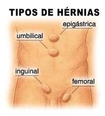 Hernias Da Parede Abdominal Dr Fabio Strauss Cirurgiao Geral Em Taquara Rs Agende Sua Consulta