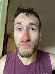 Raccoon eyes and sunburnt noses! Send us your fried pics.