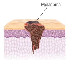 While these make up most of the cases, there are other. Types Of Skin Cancer National Council On Skin Cancer Prevention