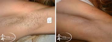Destination treatments have begun to. Laser Skin Rejuvenation Laser Hair Removal Tattoo Removal Reston Va