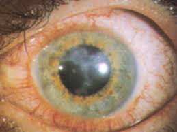 Hornhautentzundung Keratitis Augenarzt Fulda De