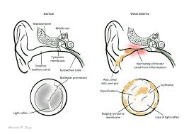 Image result for Acute Otitis Externa