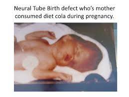 Birth Defects Caused By Aspartame Neural Tube Birth Defect Who S Mother Consumed Diet Cola During Pregnancy Ppt Download
