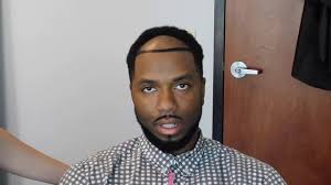 Afro hair transplantation is suitable for male and female patients who suffers from hair. Hair Restoration Clinic Procedure Day Video Hair Transplant For Black Men Youtube