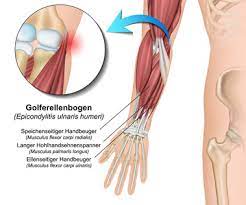 Für die bewegung des armes kommt dem ellenbogen eine bedeutende rolle zu und er wird daher auch im alltag stark beansprucht. Ellenbogenschmerzen Welche Ursachen Stecken Dahinter Gelenk Klinik De