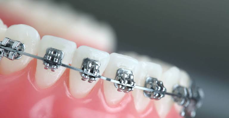 Orthodontics Australia | How are metal and ceramic braces different?
