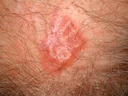 They can also look like a wart, mcneill adds. Is It Skin Cancer Cbs News