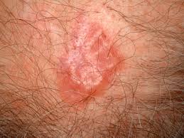 But hearing the words can still be scary. Is It Skin Cancer Cbs News