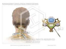 Image result for Lower Cervical Intramuscular Injection