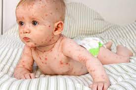 Pictures Of Viral Rashes In Adults Children