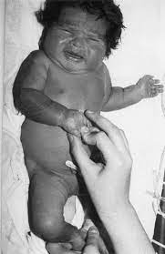 From latin hirsutus meaning hairy. Neonatal Hypertrichosis In An Infant Of A Diabetic Mother With Congenital Hypothyroidism Journal Of Perinatology