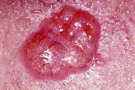 When it's diagnosed early, most people respond well to treatment. Skin Cancer Wikipedia