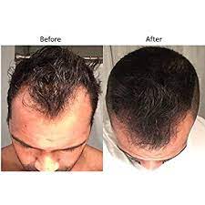 Biotin hair growth results before and after are quite mixed. Buy Spare My Hair Vitamins Shampoo Conditioner And Scalp Solution For Hair Growth With Biotin For Healthy Hair Treatment For Men Women Visible Results In 1 Month Longer Stronger Silky Soft