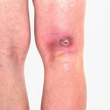 Traumatic wounds could be a result of falls, accidents, fights, bites or weapons. How To Tell A Wound Is Infected Urgentmed Network