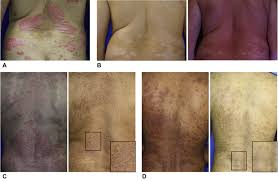 Image result for Postinflammatory Hypopigmentation