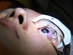 The more experience a doctor has treating your condition or performing lasik surgery, the better prepared he or she is to anticipate. I Got Laser Eye Surgery And It Was The Best Decision I Ever Made
