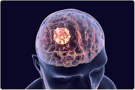 A person's likelihood of developing this type of tumor in their lifetime is less than 1%. Treating Brain Tumors