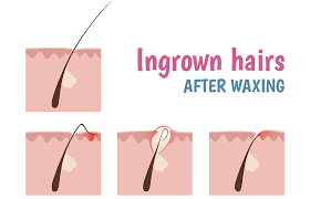 They may be feel painful ingrown hair can occur in between the thighs or on the back of your legs. How To Get Rid Of Ingrown Hairs