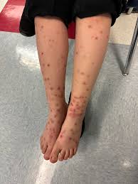 Image result for scabies bite
