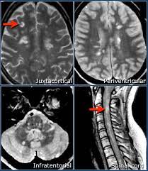 Changes in sensation (hypoesthesia), muscle weakness, abnormal muscle spasms, or difficulty moving; The Radiology Assistant Multiple Sclerosis Diagnosis And Differential Diagnosis