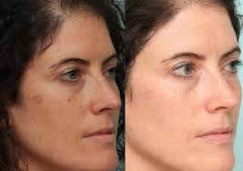 Yuzdeki Siyah Lekeler Icin Maske Black Spots On Face Black Patches On Face Spots On Face