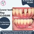 Front teeth gap closure product image