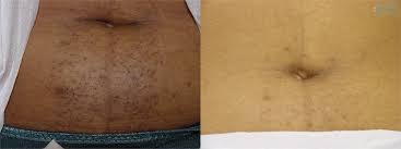 Pcos laser hair removal treatment areas the only areas on women that cannot be treated with laser hair removal are the inside of the ears and the inside of the nose. Laser Hair Removal Baltimore Maryland Hunt Valley